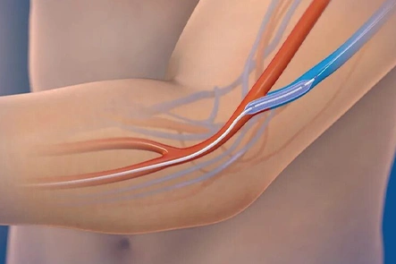  Procedure of AV Fistula Creation