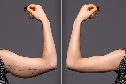 Benefits of Arm Lift Surgery