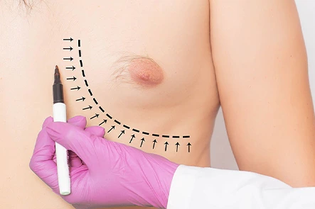 male breast reduction 