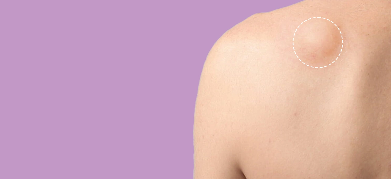 Lipoma Removal Surgery