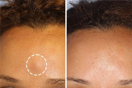 Procedure Of Lipoma Removal Surgery