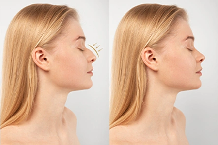 benefits of Rhinoplasty surgery