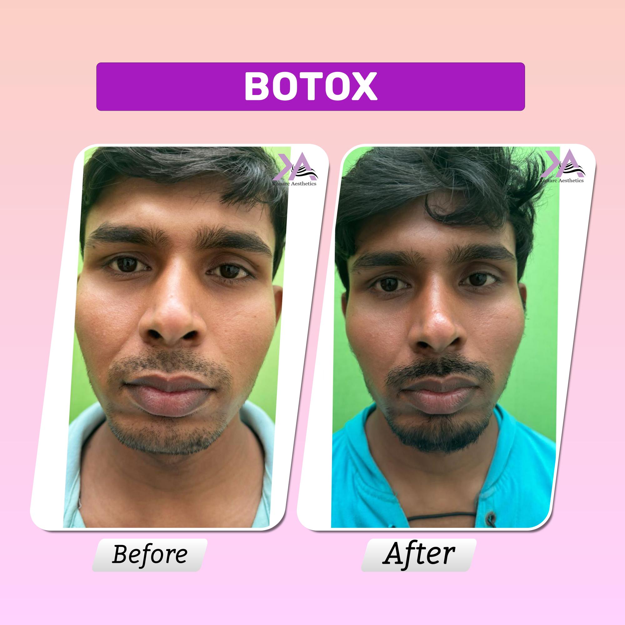 Masseter before and after results
