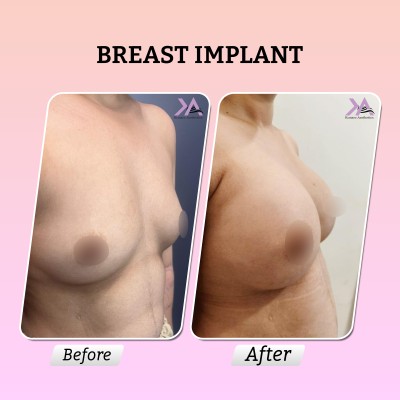 Breast augmentation result