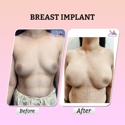 Breast implant before after result