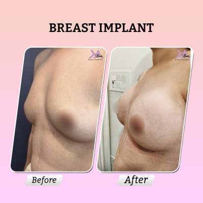 Breast implant surgery result