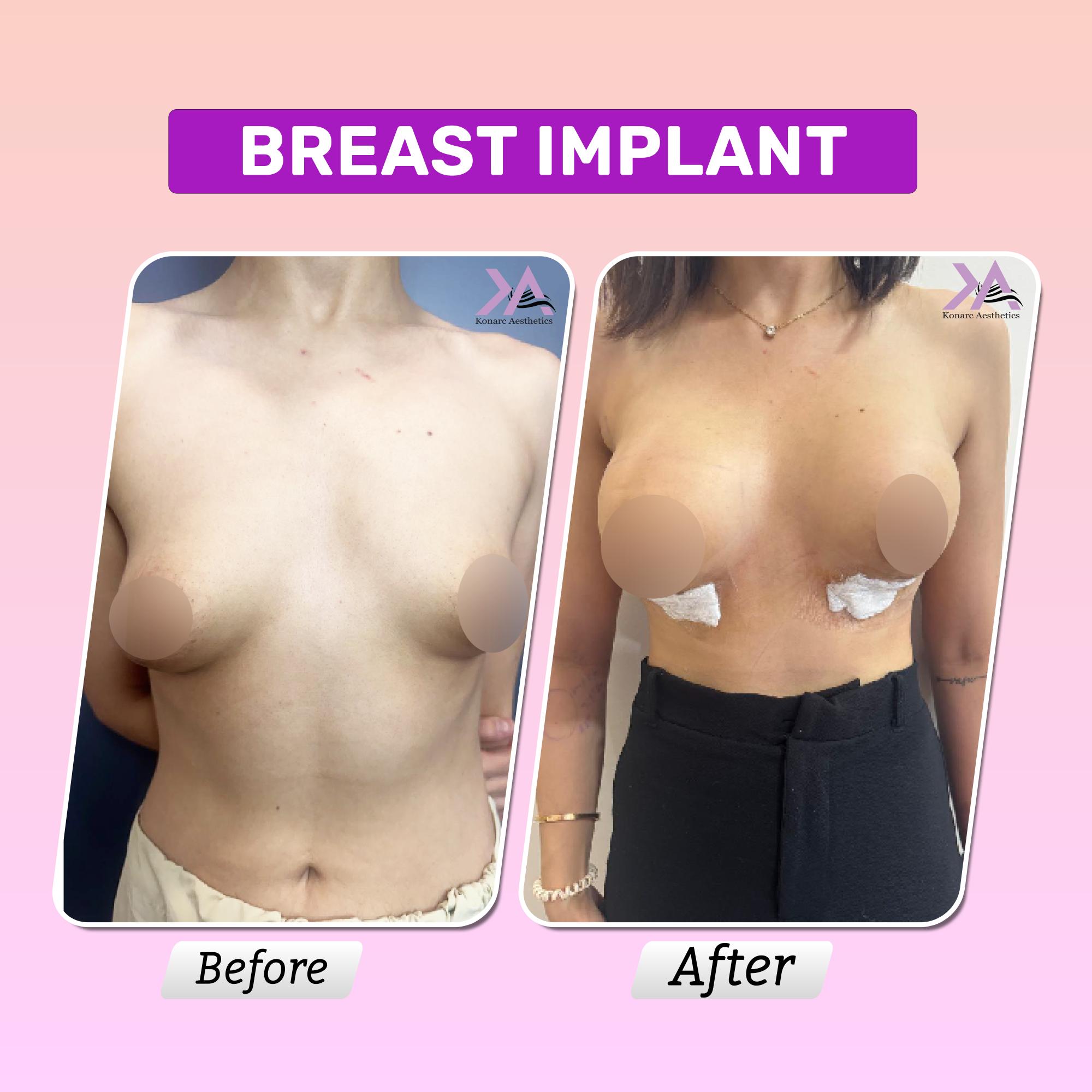 Breast implant before after