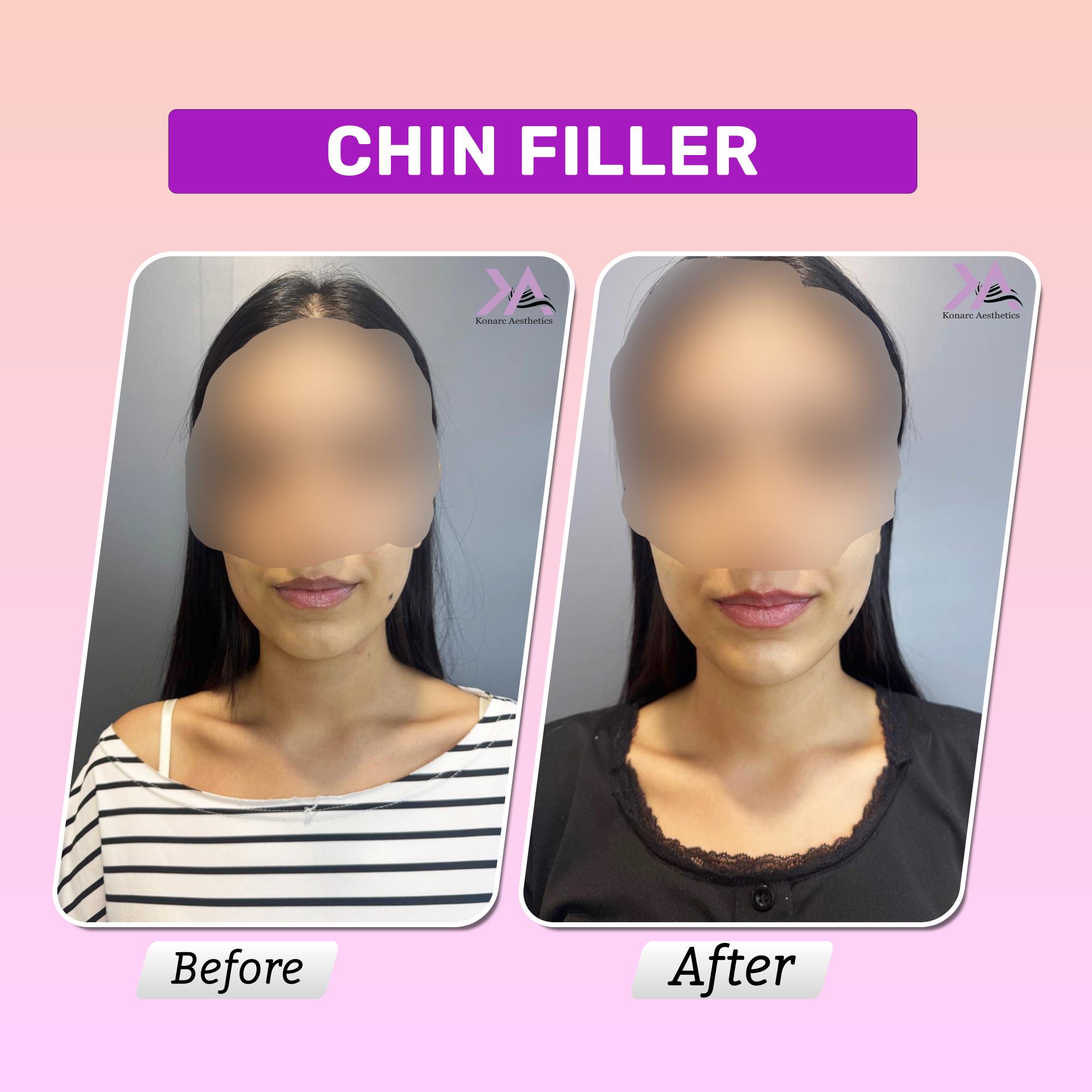Chin filler before after
