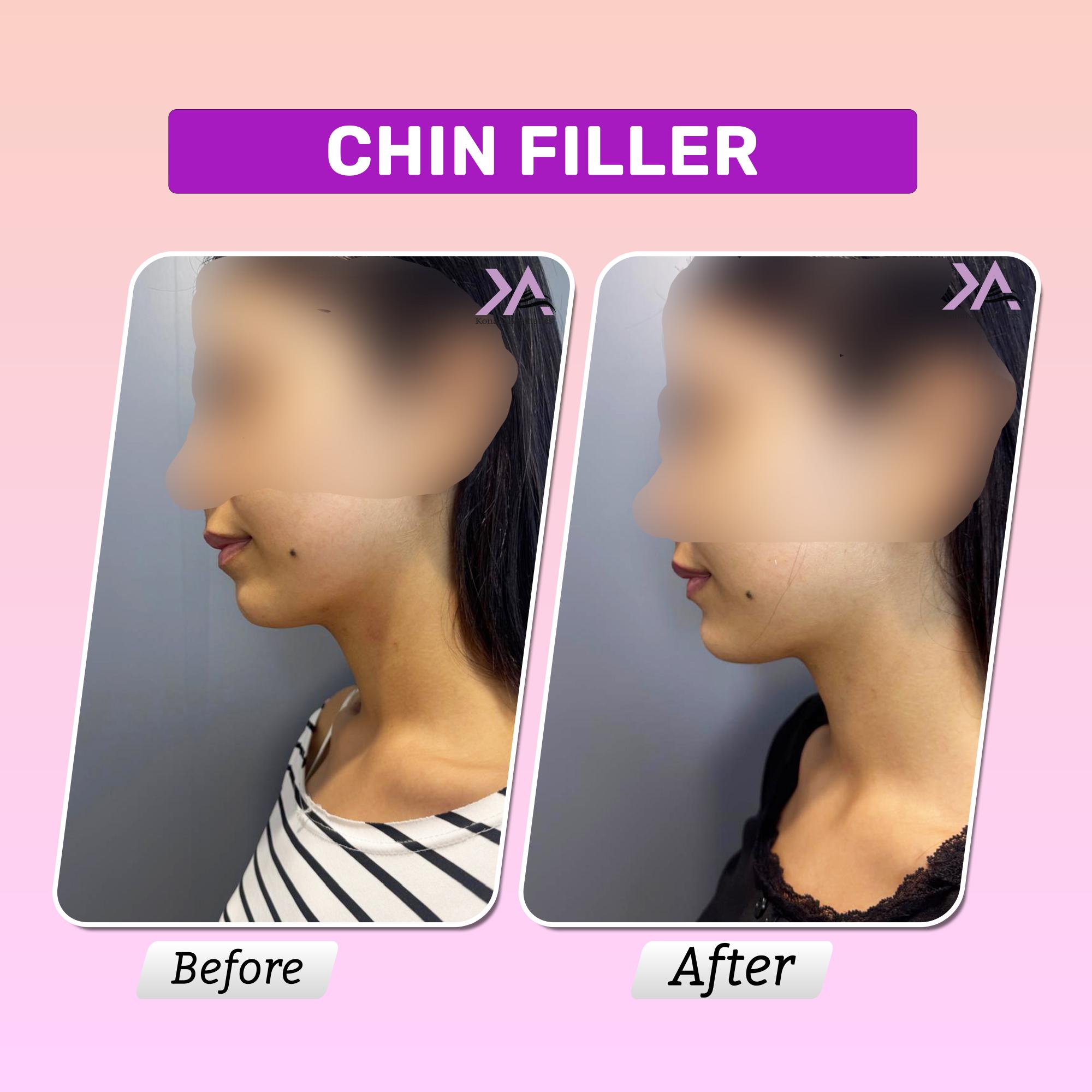 Chin filler result 1