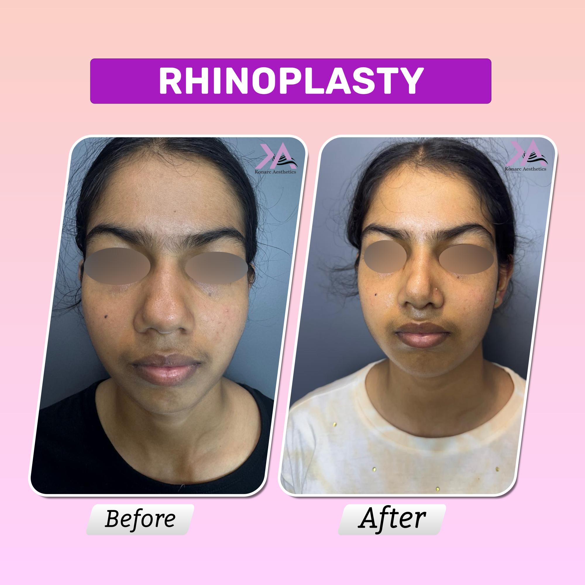Rhinoplasty result 1
