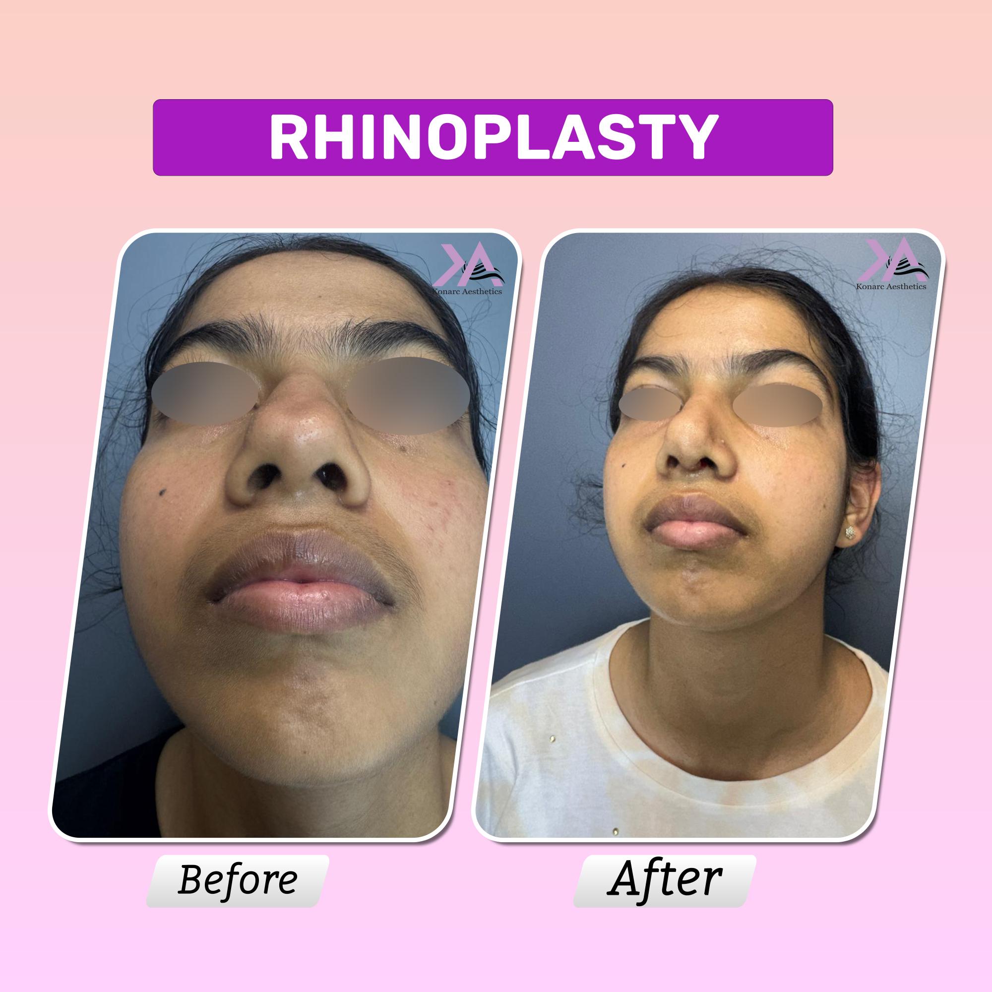 Rhinoplasty result 4