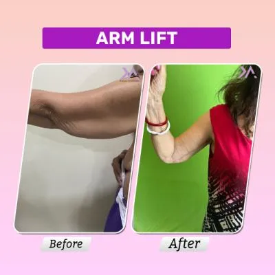 Arm lift result 2