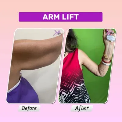 Arm lift result 1