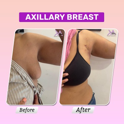 Breast Surgery result 1