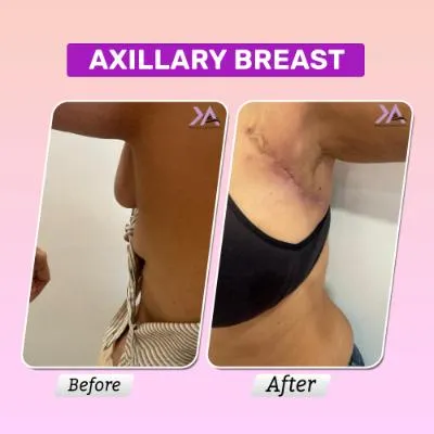 Axillary breast surgery result