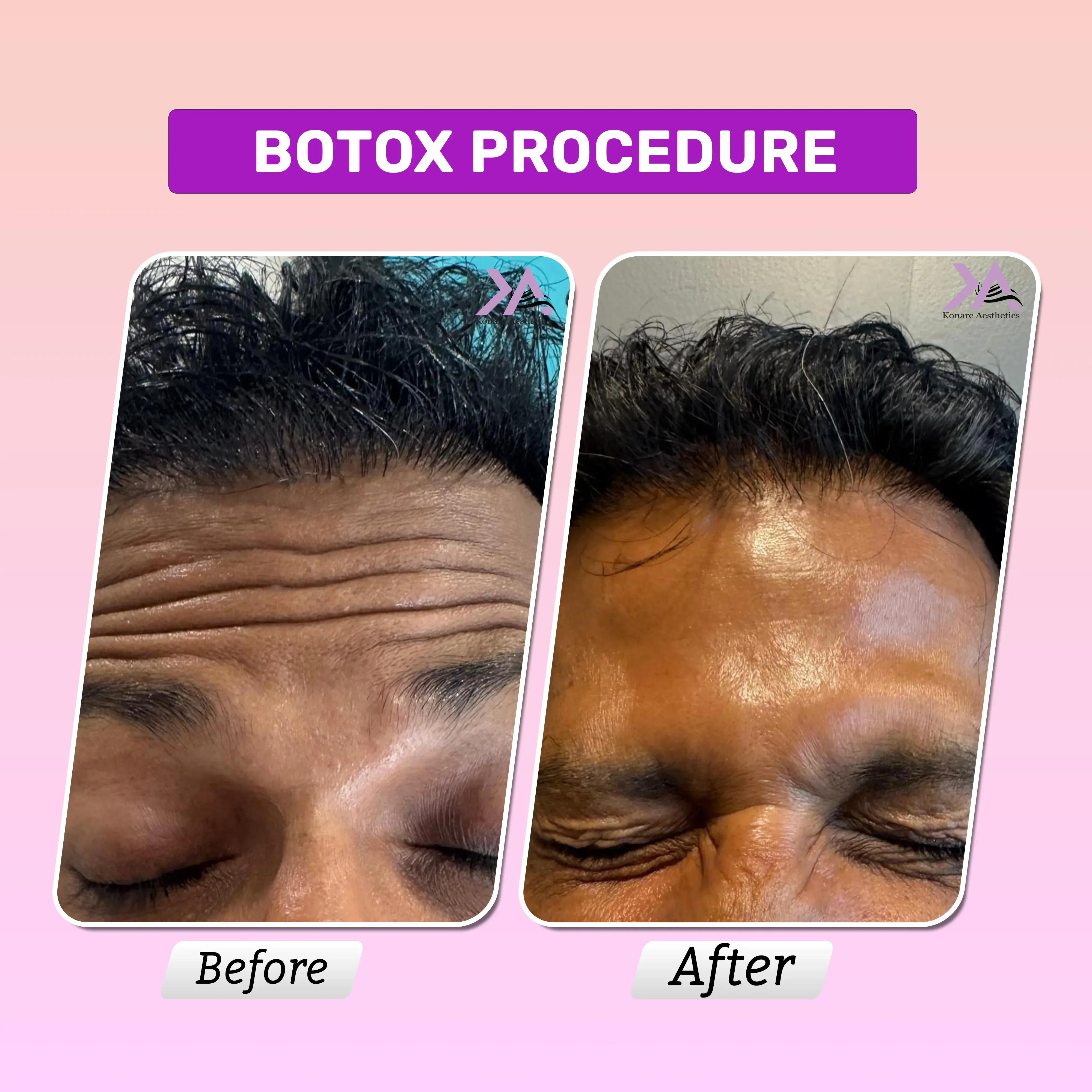 Masseter before and after results