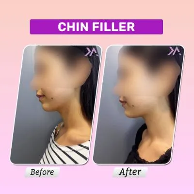 Chin filler result 2