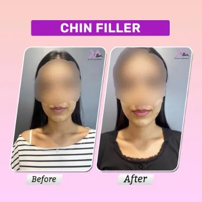 Chin filler result 3
