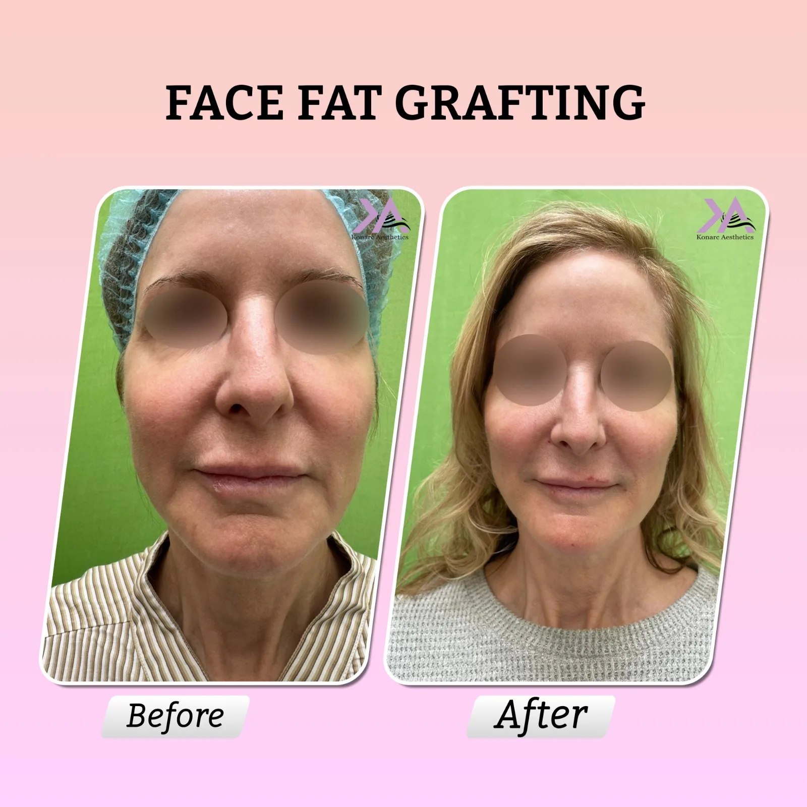 Face Fat Grafting