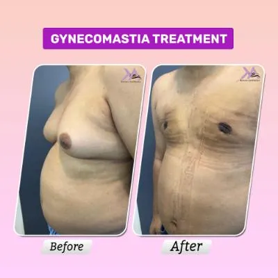 Gynecomastia before after result