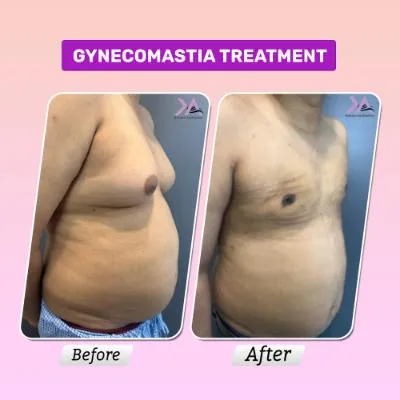 Gynecomastia surgery result