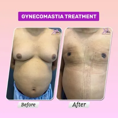 Gynecomastia treatment before after