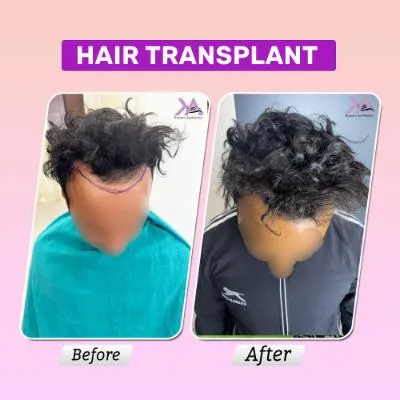 Hair transplant result