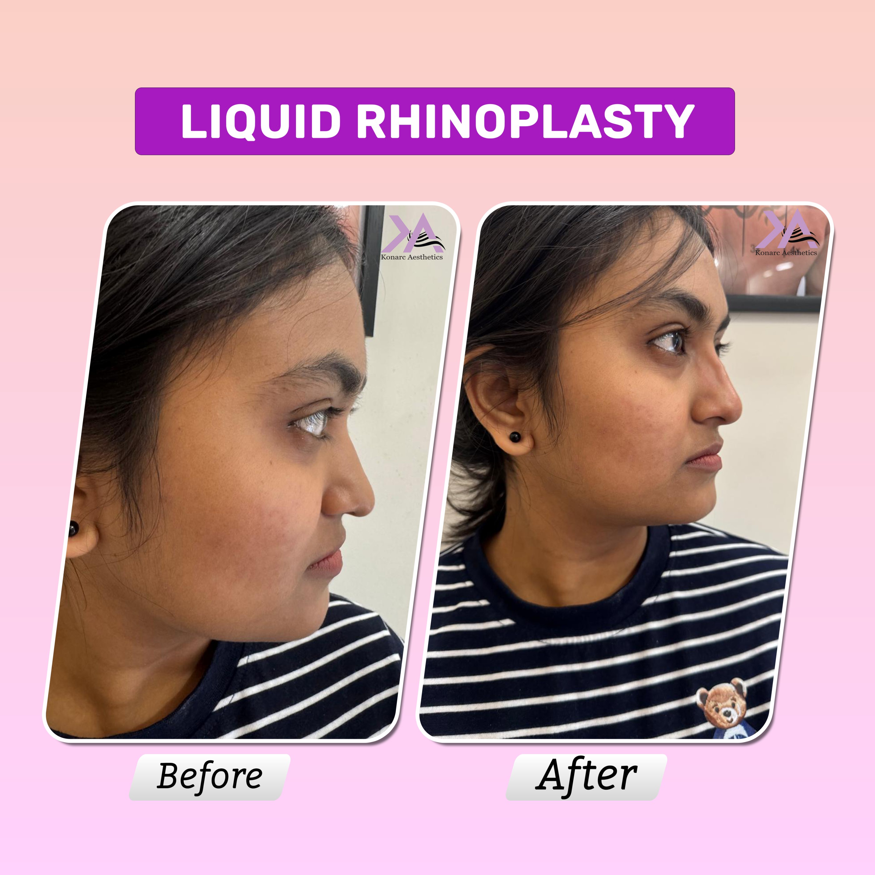 Liquid rhinoplasty result 1