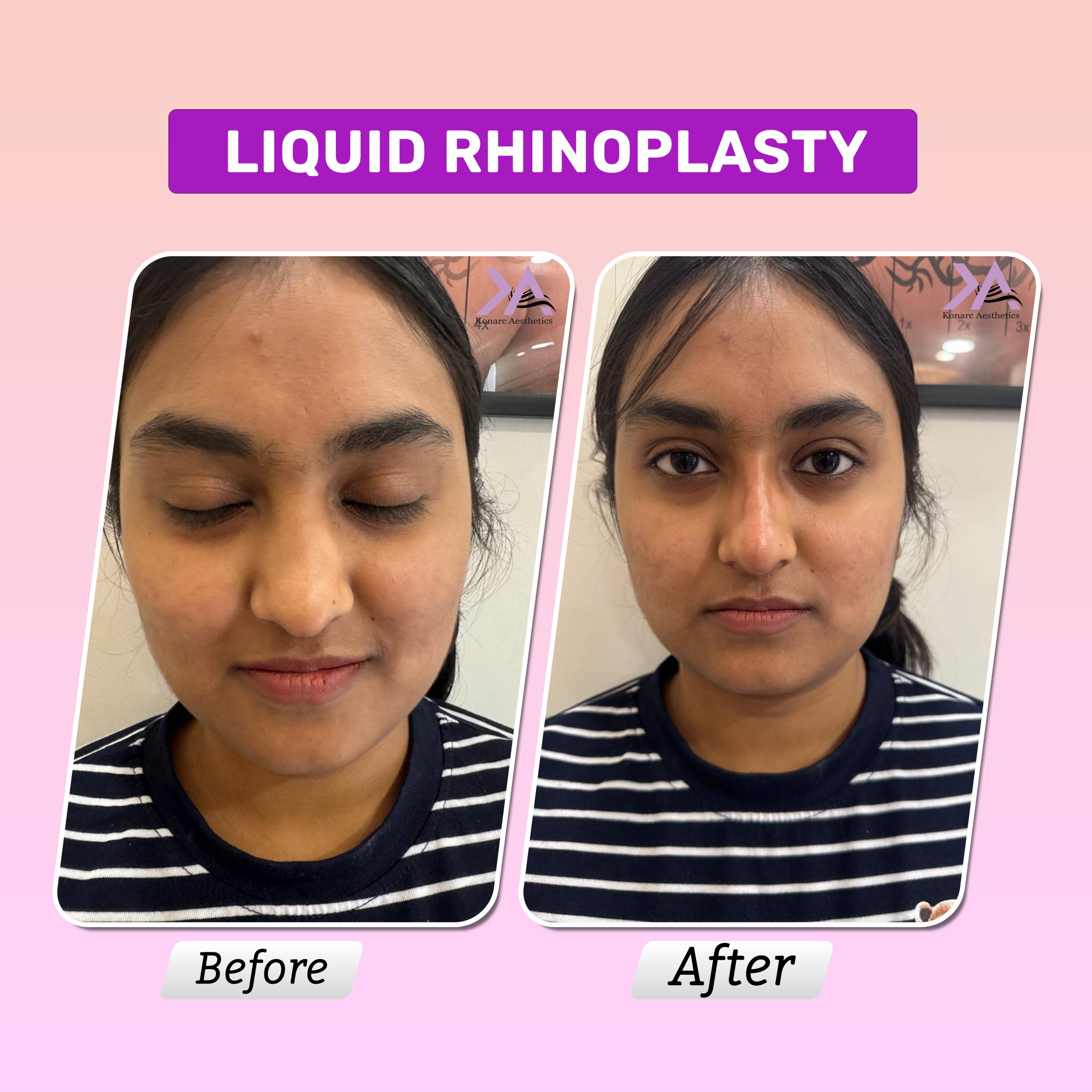 Liquid rhinoplasty result 2
