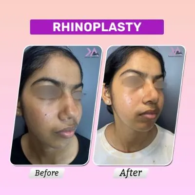 Rhinoplasty result 5