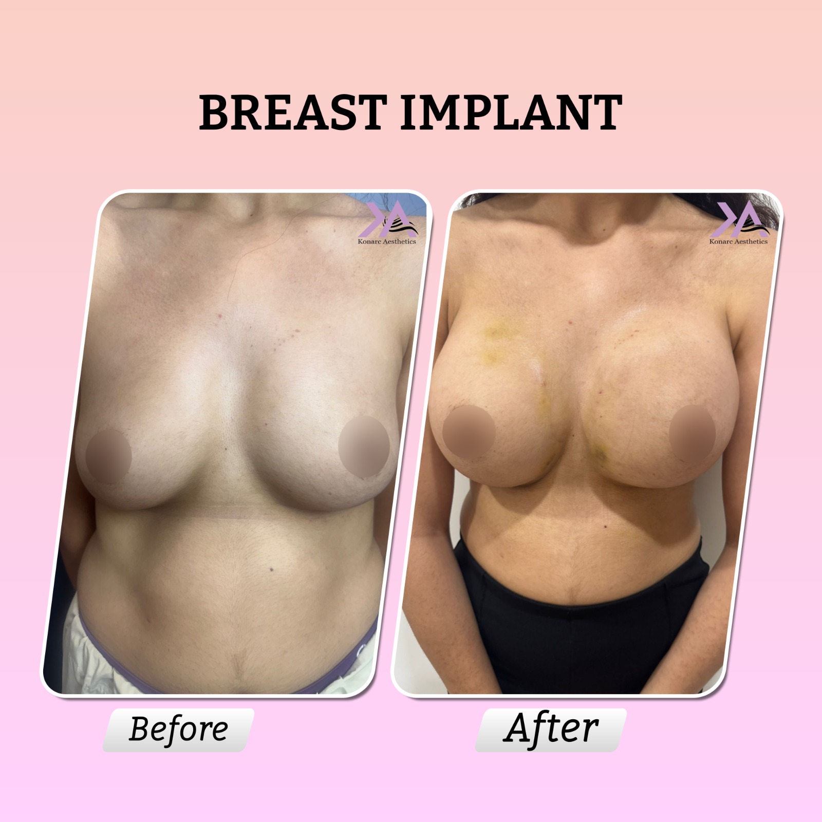 Breast axillary result 2