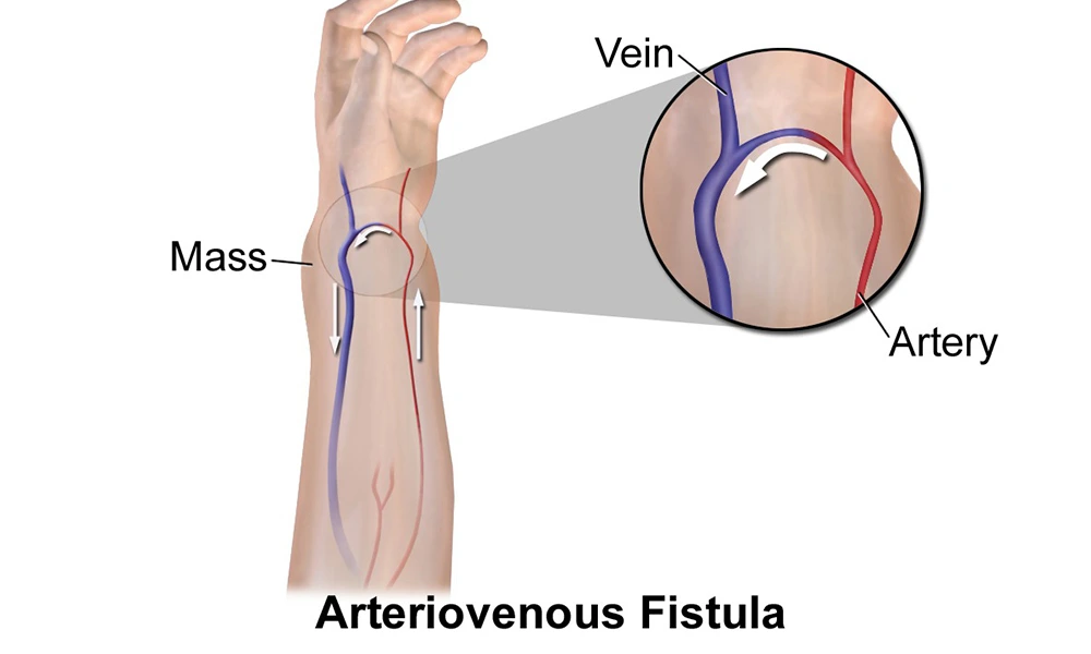 AV Fistula