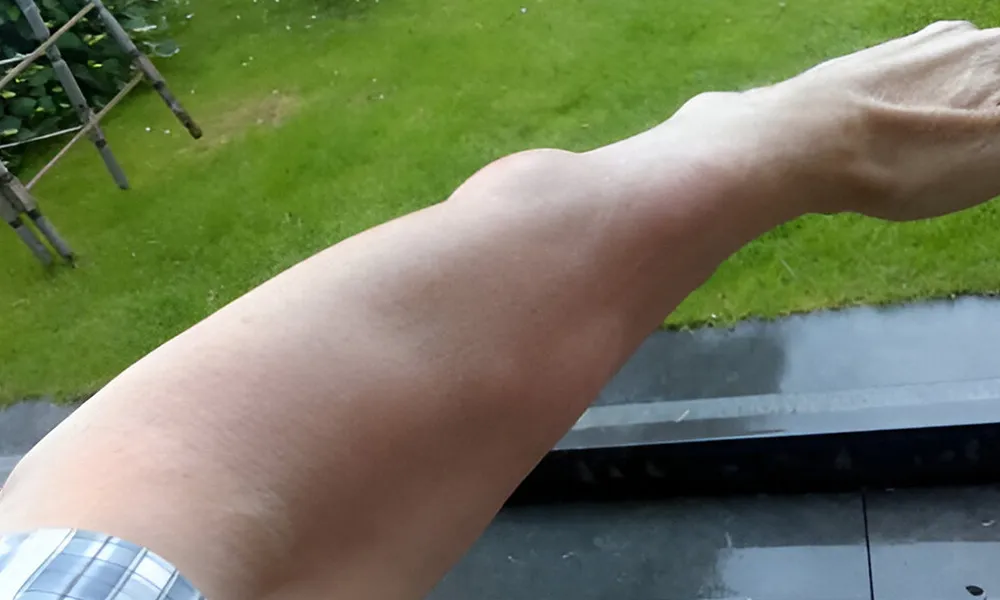 Lipoma Removal Surgery