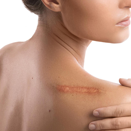 Benefits of AV Fistula