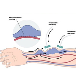 AV Fistula Surgery