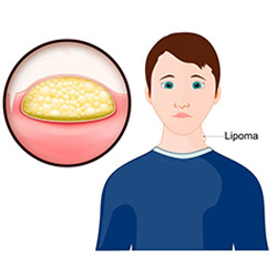 Lipoma Removal Surgery