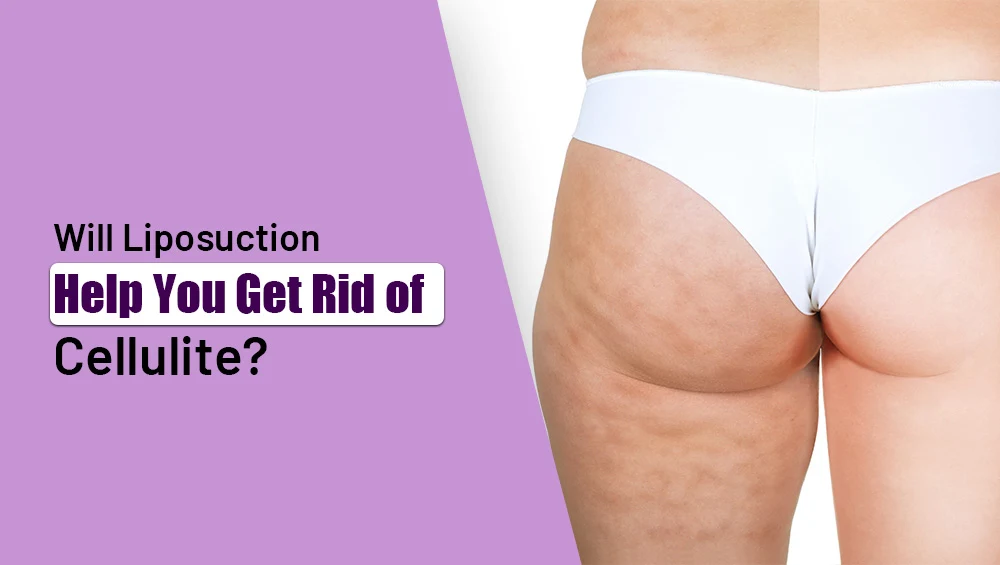 Get Rid of Cellulite: Will Liposuction Help You?