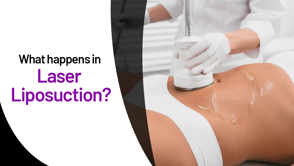What Happens in Laser Liposuction?