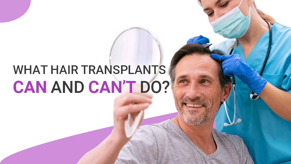 What Hair Transplants Can and Can’t Do?