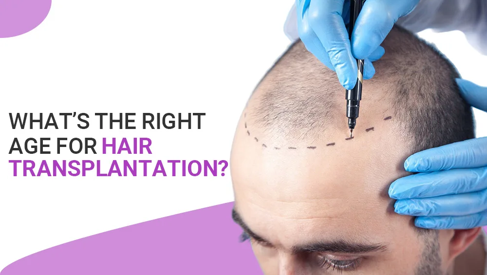 What’s the Right Age for Hair Transplantation?