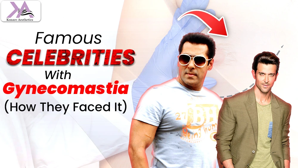 Celebrities with gynecomastia