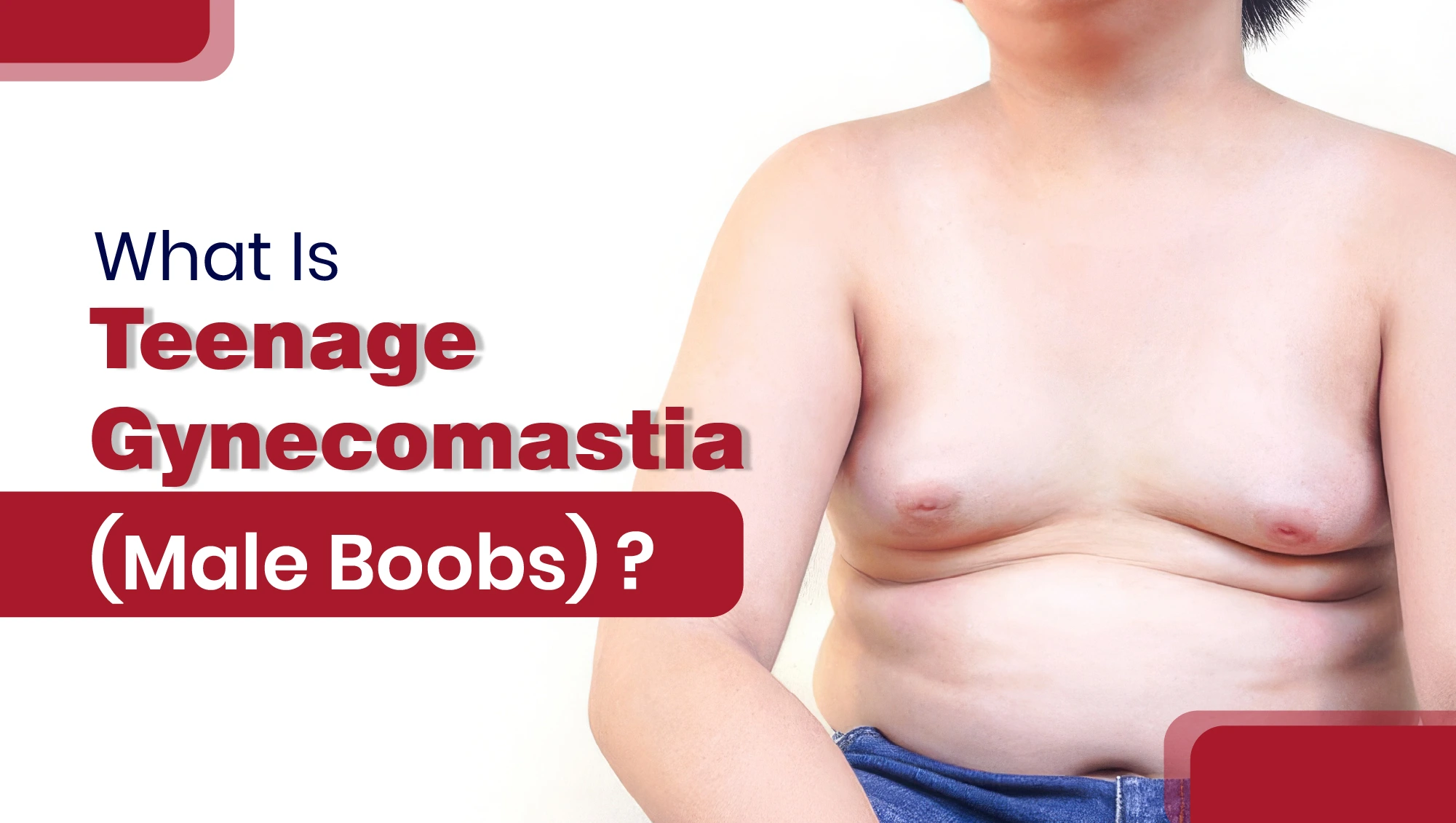 What Is Teenage Gynecomastia?