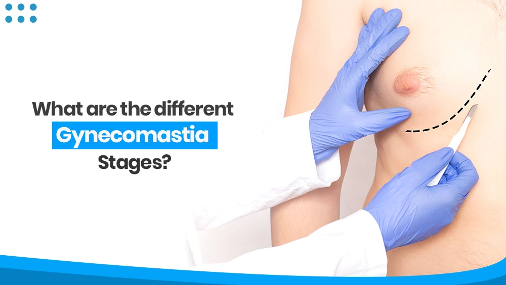 What Are The Different Gynecomastia Stages?