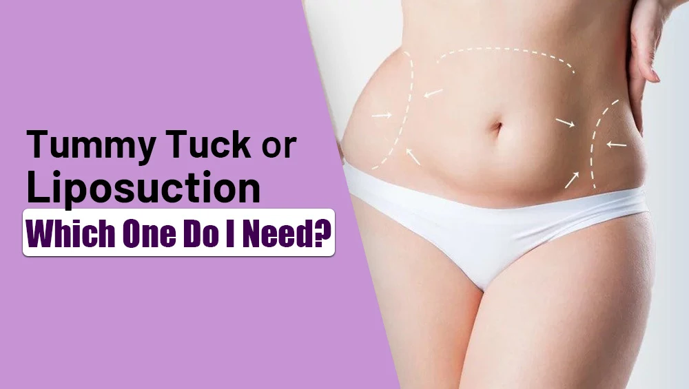 Tummy Tuck vs Liposuction – Which One Do I Need?