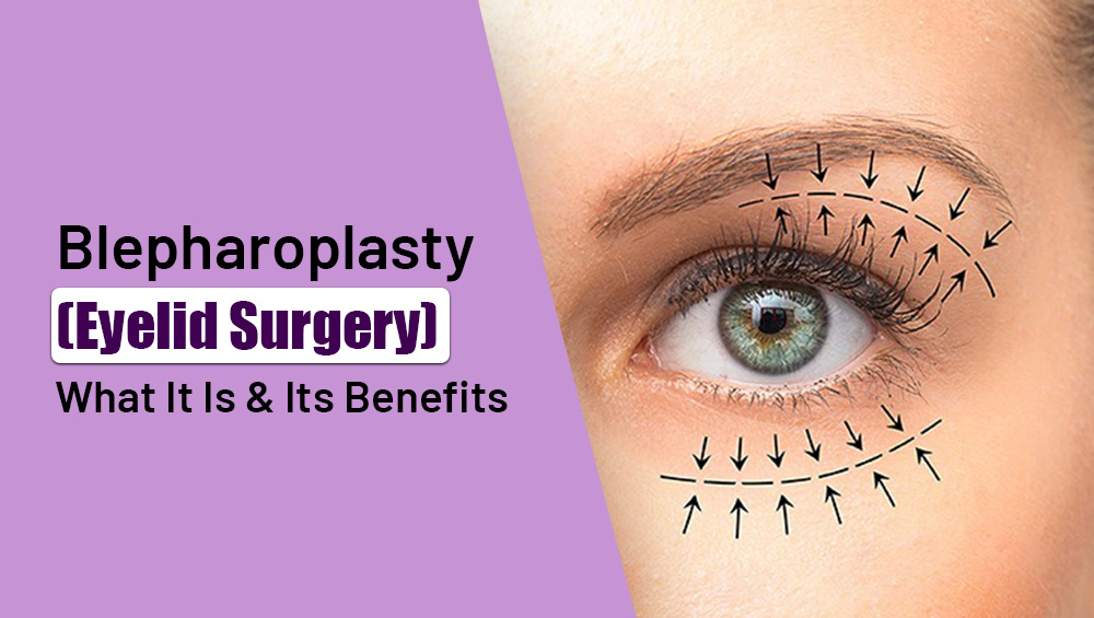 Blepharoplasty (Eyelid Surgery): What It Is & Its Benefits