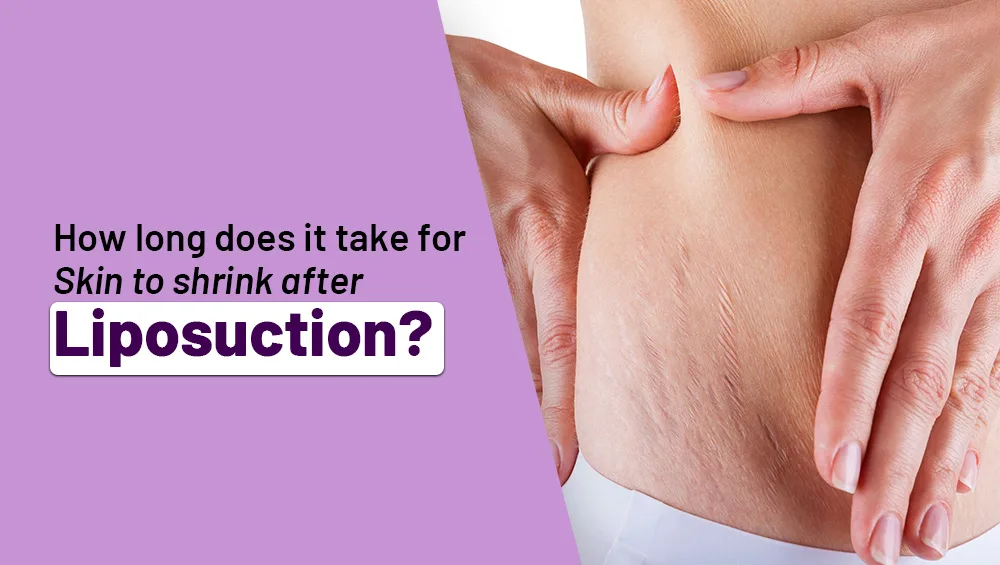 How Long Does It Take For Skin To Shrink After Liposuction?