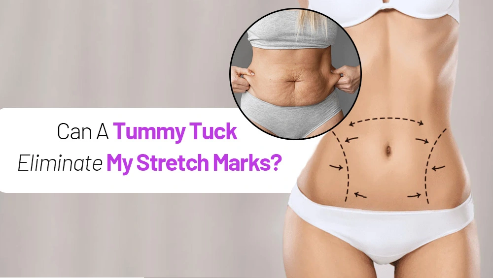 Can A Tummy Tuck Remove My Stretch Marks?