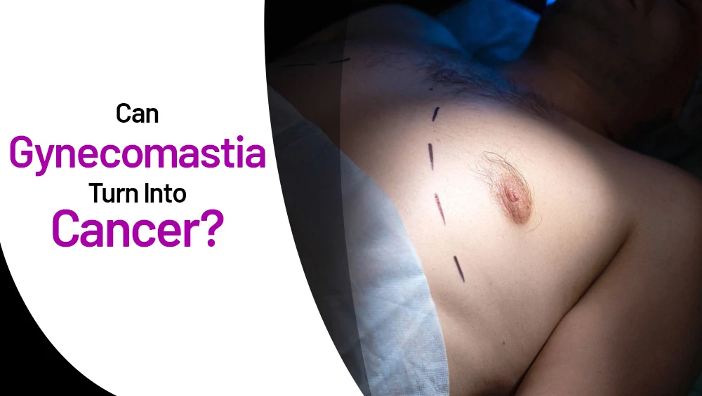 Can Gynecomastia Turn Into Cancer? Risks & Myths