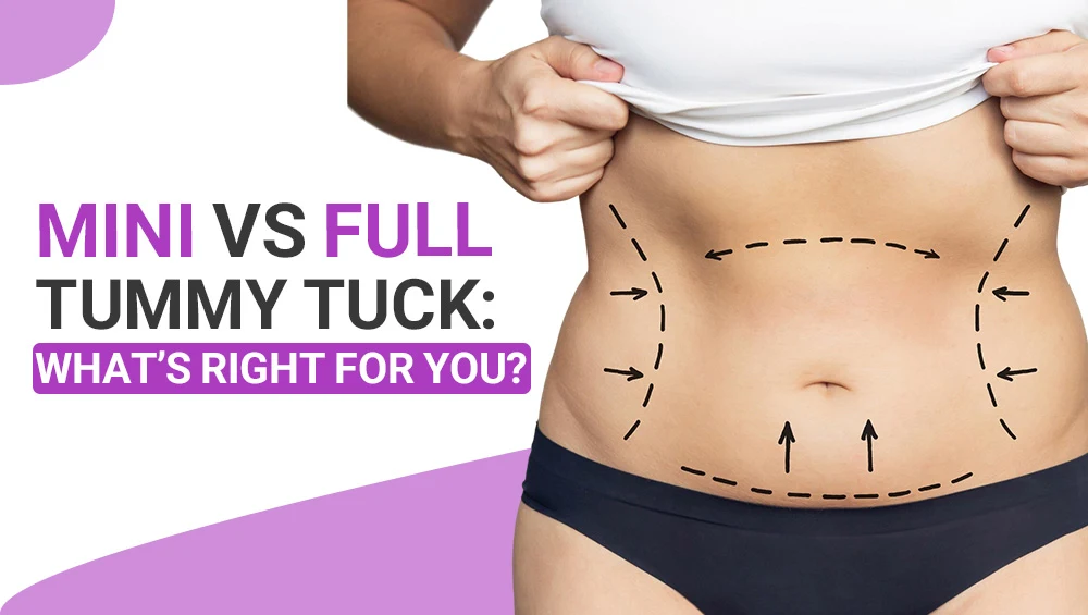 Mini vs. Full Tummy Tuck: What’s Right for You