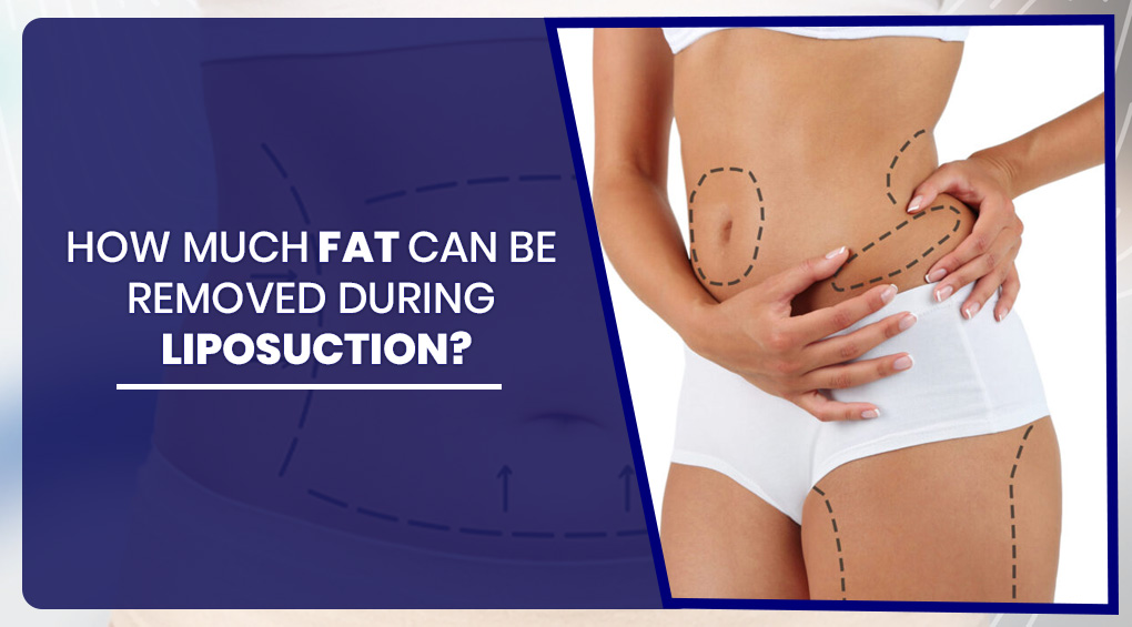 How Much Fat Can Be Removed During Liposuction?